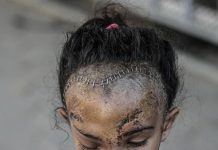 Kisah Sila, Selamat dari Bom, tapi tak Bisa Berobat karena Blokade Israel