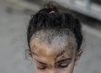 Kisah Sila, Selamat dari Bom, tapi tak Bisa Berobat karena Blokade Israel