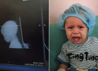 Keajaiban Medis: Dokter Gaza Operasi Bayi yang Kepalanya Ditembak Israel