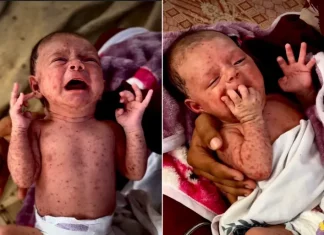 “Wabah di Dalam Tenda”: Cacar Air Mengerogoti Tubuh Anak-Anak Gaza